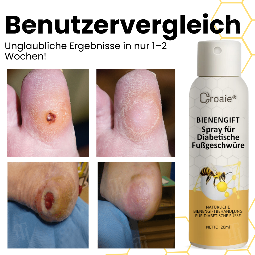 Croaie® Bienengift Spray für Diabetische Fußgeschwüre