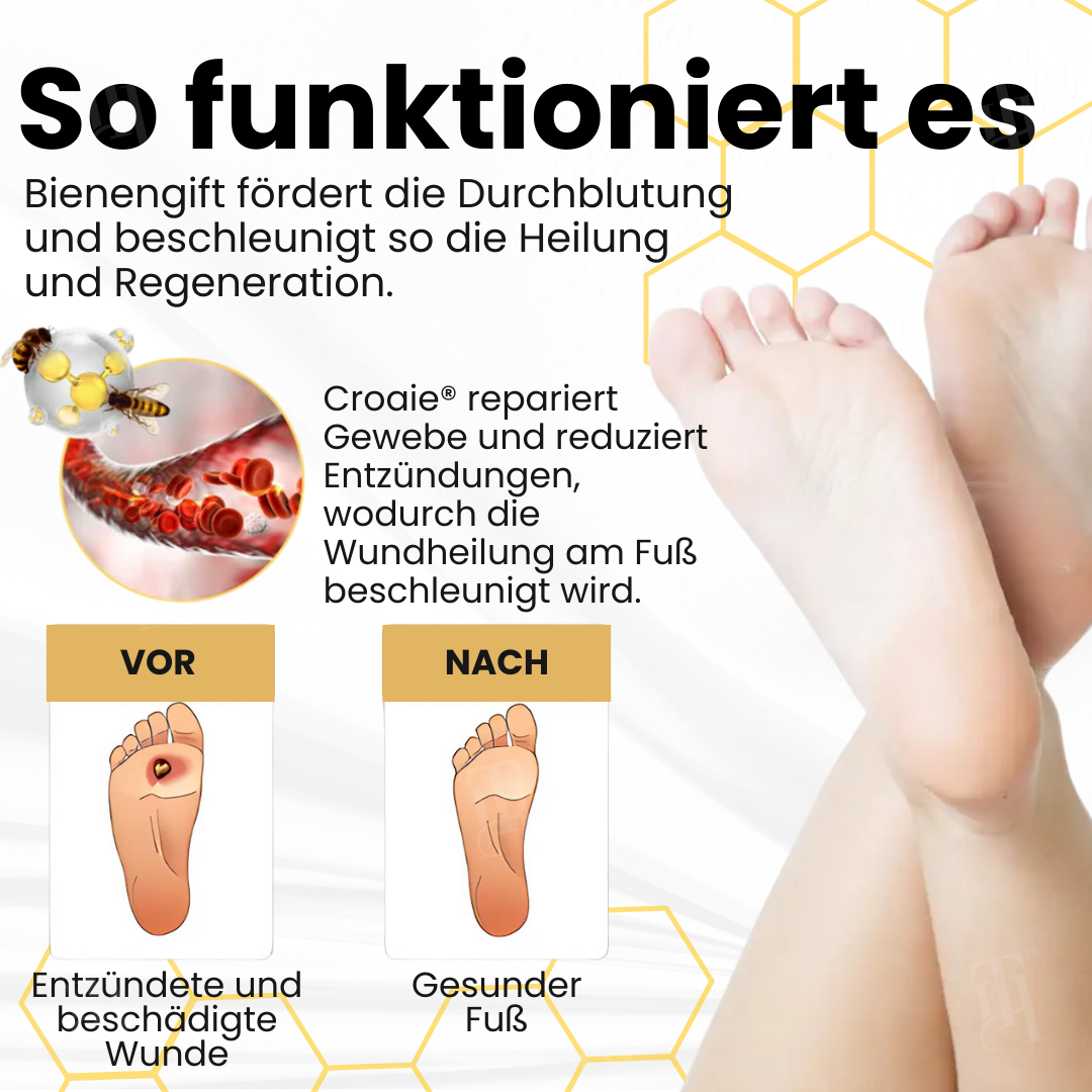 Croaie® Bienengift Spray für Diabetische Fußgeschwüre