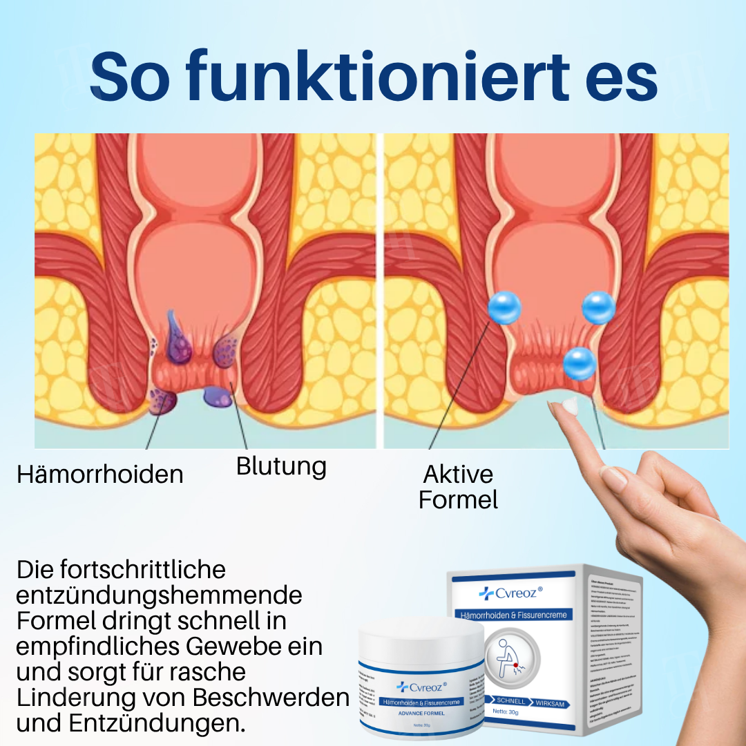 [Offizieller Shop] Cvreoz® Hämorrhoiden & Fissurencreme-In 7 Tagen schmerzfrei – garantiert!
